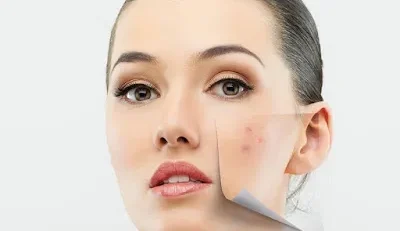 homemade acne face mask with egg white and honey