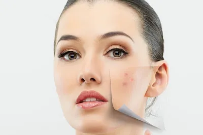 homemade acne face mask with egg white and honey